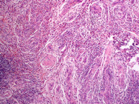 Angiolymphoid hyperplasia with eosinophilia