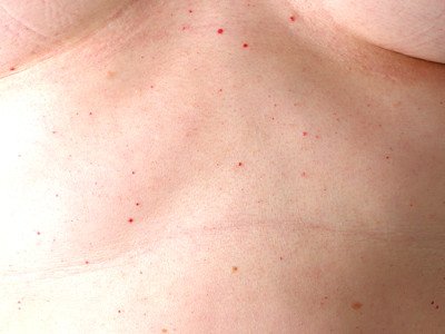 haemangioma senilis, cherry angioma