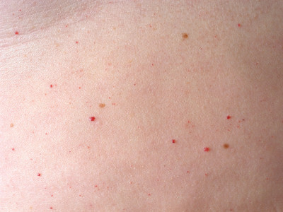 haemangioma senilis, cherry angioma