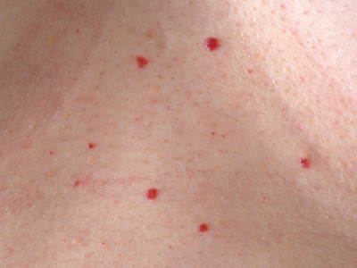 haemangioma senilis, cherry angioma