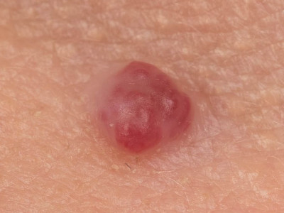 haemangioma senilis, cherry angioma