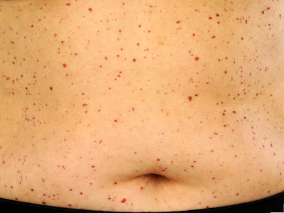 haemangioma senilis, cherry angioma