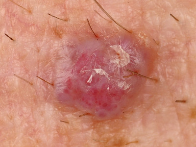 haemangioma senilis, cherry angioma