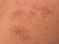 Angioma serpiginosum