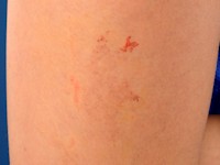 Angioma serpiginosum