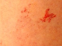 Angioma serpiginosum