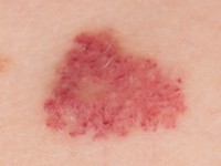 Angioma serpiginosum