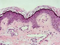 Angioma serpiginosum