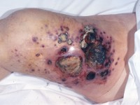 Angiosarcoma