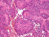 Histologie angiosarcoma