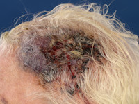 Angiosarcoma
