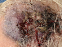 Angiosarcoma
