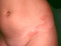 Annular lichenoid dermatitis of youth