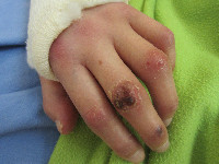 Anti-MDA5-associated dermatomyositis