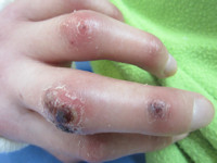Anti-MDA5-associated dermatomyositis