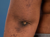 Anti-MDA5-associated dermatomyositis