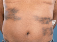 TNF-alfa induced lupus