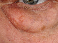 Apocrien hidrocystoma