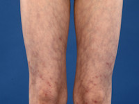 livedo reticularis bij anti-fosfolipiden syndroom