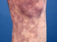 livedo reticularis bij anti-fosfolipiden syndroom