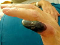 anti-fosfolipiden syndroom