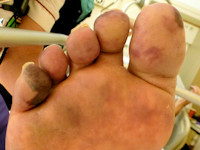 anti-fosfolipiden syndroom