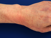 Aquagene urticaria