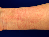 Aquagene urticaria