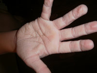 Aquagenic wrinkling of the palms