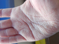 Aquagenic wrinkling of the palms