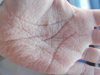 Aquagenic wrinkling of the palms