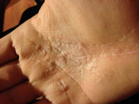 Aquagenic wrinkling of the palms