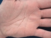 Aquagenic wrinkling of the palms