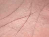 Aquagenic wrinkling of the palms