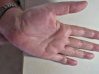 Aquagenic wrinkling of the palms