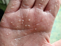 Aquagenic wrinkling of the palms