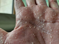 Aquagenic wrinkling of the palms