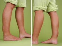 Arterioveneuze fistel