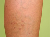 Arterioveneuze fistel