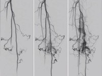 Arterioveneuze fistel