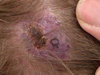 Arterioveneuze malformatie