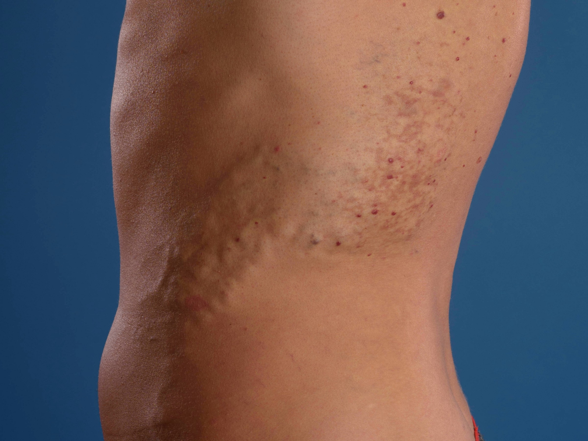 Arterioveneuze malformatie