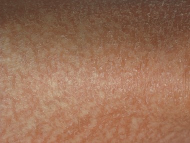 Dry skin with atopy