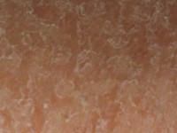 Droge huid bij atopie