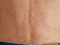 Droge huid bij HIV infectie