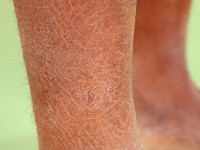 Droge huid bij lepra