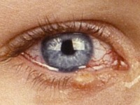 Ataxia telangiectasia