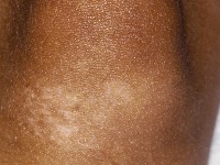 Ataxia telangiectasia