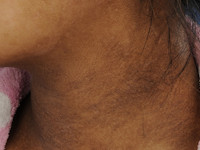 Atopic dirty neck sign