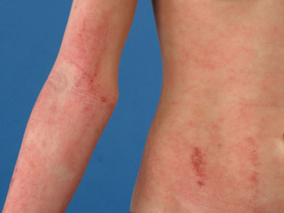 Atopisch eczeem van de knieholten